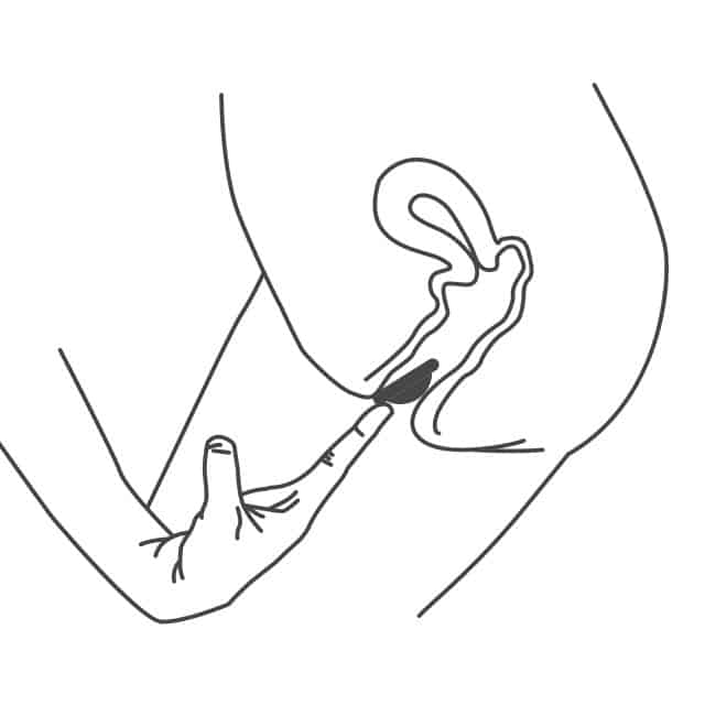 To fit a diaphragm or cap, you must apply spermicide then insert into the vagina until it covers the cervix