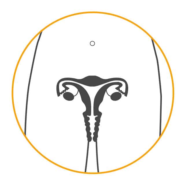 Diaphragms and caps cover the cervix, which is right at the top of the vagina
