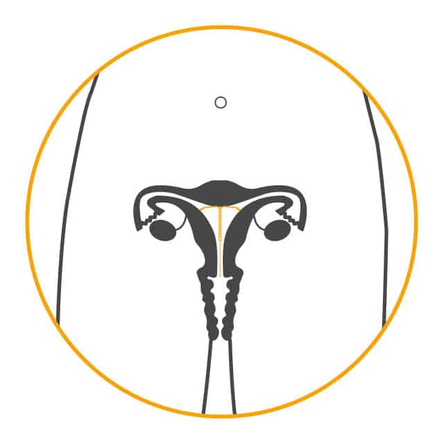 The IUS is inserted inside the vagina